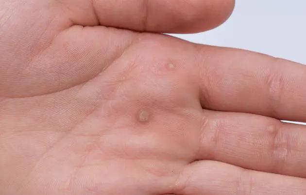HPV Nedir? HPV Tanısı, HPV Aşısı, HPV Aşısı Hakkında Sıkça Sorulan Sorular nelerdir?