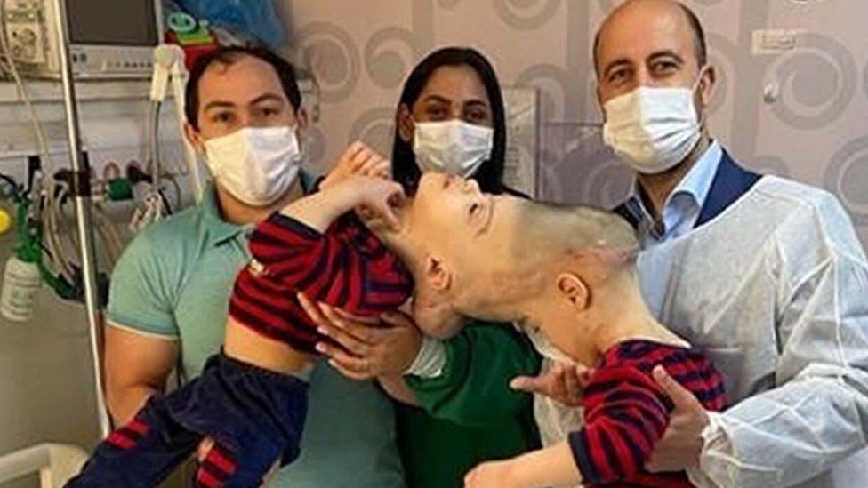 Yapışık ikizler sanal gerçeklikle ayrıldı