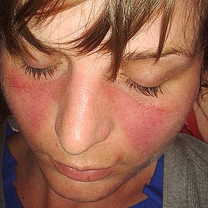 Lupus Hastalığı nedir? Lupus hastalığı nedenleri nelerdir? Lupus hastalığı belirtileri nelerdir? Lupus hastalığı kimlerde görülür? Lupus hastalığı nasıl bir seyir izler? Lupus hastalığı ölümcül müdür? Lupus hastalığı tedavisi?