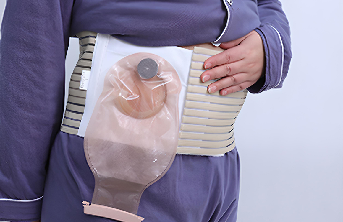 Stoma Nedir? Stomaya Neden İhtiyaç Duyulur? Stoma Çeşitleri Nelerdir? Stoma Hangi Durumlarda Tercih Edilir? Stomanın Özellikleri Stomanın Bazı Olası Komplikasyonları Nelerdir? Stoma Bakımı Nasıl Olmalı? Stoma Aparatı Değiştirme Sıklığı Nasıl Olmalıdı