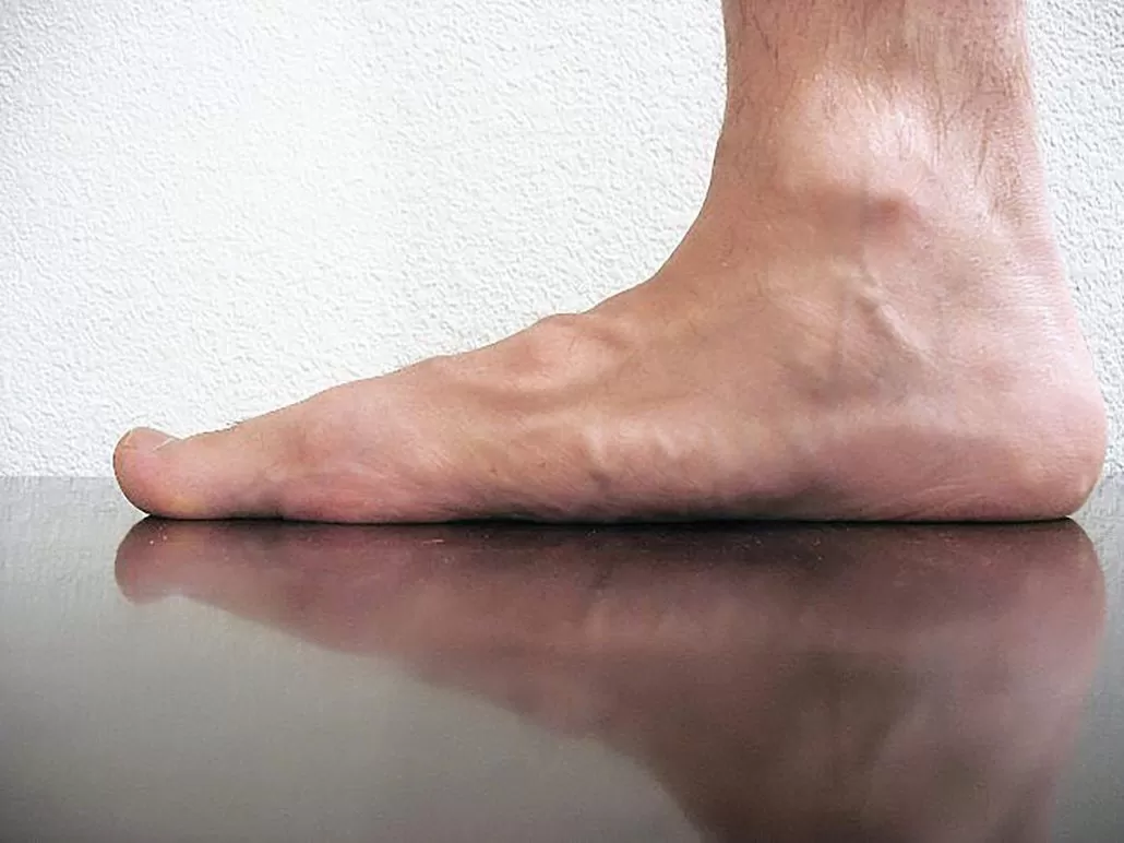 Düz Tabanlık Nedir? Düz Tabanlık Belirtileri Nelerdir? Düz Tabanlık Neden Olur? Düz Tabanlık Çeşitleri Nelerdir? Düz Tabanlık Teşhisi Nasıl Konulur? Düz Tabanlık Tedavisi Nasıldır?
