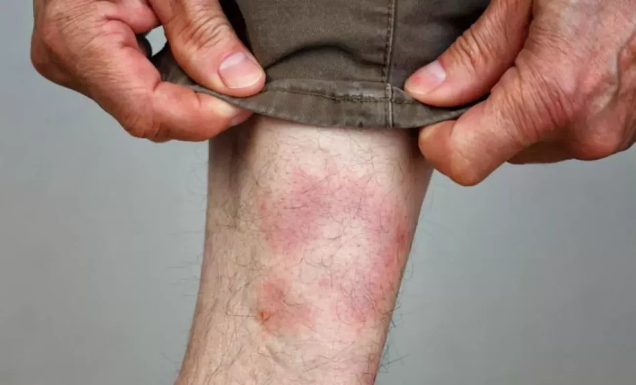 Lyme hastalığı